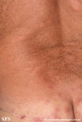 leprosy borderline