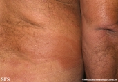leprosy borderline