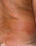 leprosy borderline