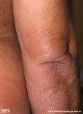 leprosy borderline