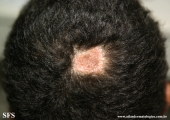 naevus sebaceous