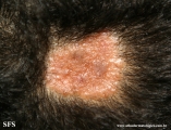 naevus sebaceous