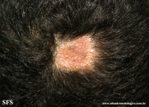 naevus sebaceous