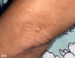xanthoma eruptive