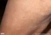 xanthoma eruptive