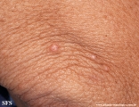 xanthoma eruptive
