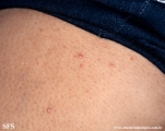 xanthoma eruptive