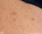 xanthoma eruptive