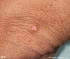 xanthoma eruptive