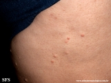 xanthoma eruptive