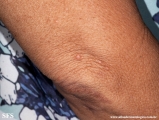 xanthoma eruptive