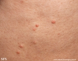 xanthoma eruptive