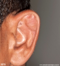 pseudocyst of the ear