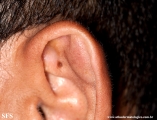 pseudocyst of the ear