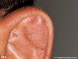 pseudocyst of the ear