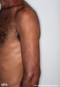 leprosy borderline