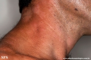 leprosy borderline
