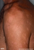 leprosy borderline
