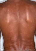 leprosy borderline