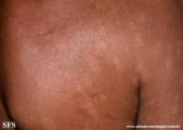 leprosy borderline