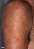 leprosy borderline