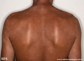 leprosy borderline