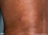 leprosy borderline