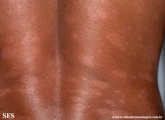 leprosy borderline