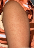 keratosis pilaris