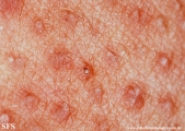 keratosis pilaris