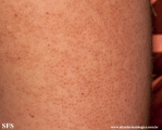 keratosis pilaris