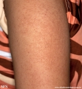 keratosis pilaris