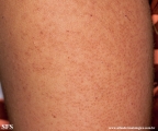 keratosis pilaris