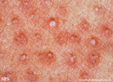 keratosis pilaris