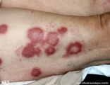 leprosy borderline