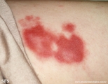 leprosy borderline