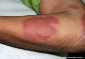 leprosy borderline