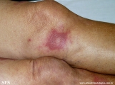 leprosy borderline