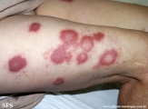 leprosy borderline