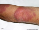 leprosy borderline