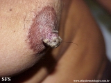 dermatosis neglecta