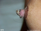 dermatosis neglecta