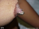 dermatosis neglecta