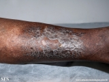 dermatosis neglecta