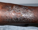 dermatosis neglecta