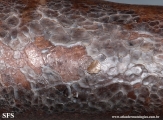 dermatosis neglecta
