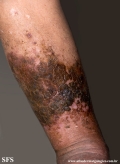 dermatosis neglecta