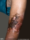 dermatosis neglecta