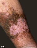 dermatosis neglecta