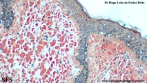 amyloidosis-nodular amyloidosis